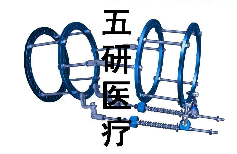 Ilizarov��̶���--����ϥ�ؽڹ���