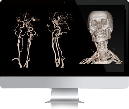 i-3DѪ�ܷ���ģ��