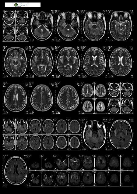 ҽ��ֽ�ʽ�Ƭ