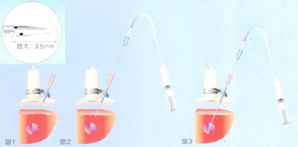 �ձ��˹⾭Ƥ�ƾ�ע���Ʒ���