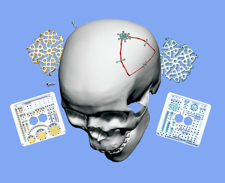 ����OSTEOMED����