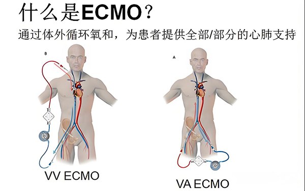 �߾���ECMO��Ũ�ȵ��������ѡ��е�����������������ȶ������ȸ�