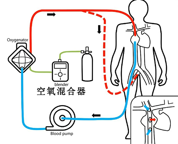 �߾���ECMO��Ũ�ȵ��������ѡ��е�����������������ȶ������ȸ�