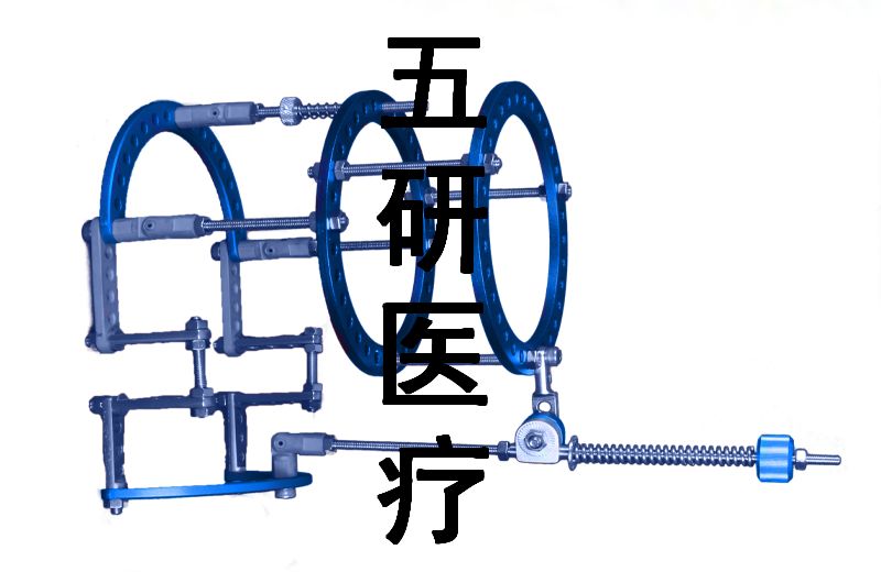 Ilizarov��̶���--���׹���