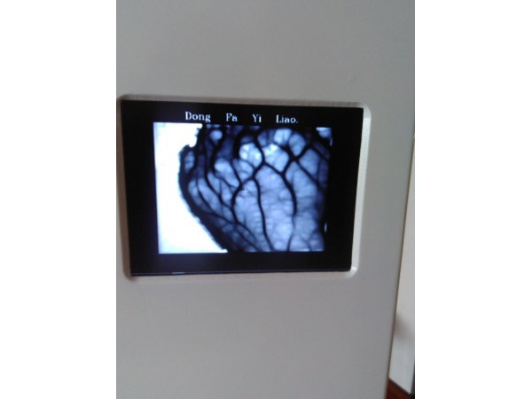 东发医疗厂家招商 静脉显像仪血管显像仪 静脉穿刺必备