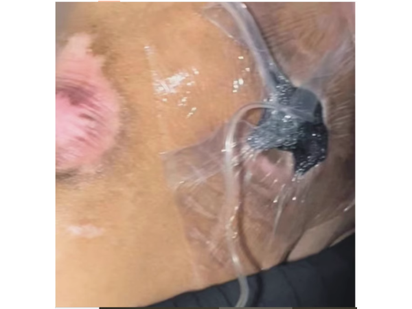 医用透明敷贴20x30cm封闭负压引流VSD 护创无菌敷贴膜vsd